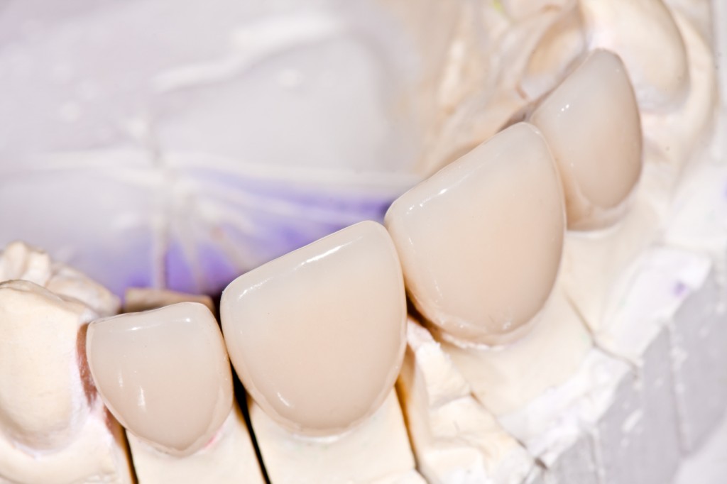 Ceramic crowns
